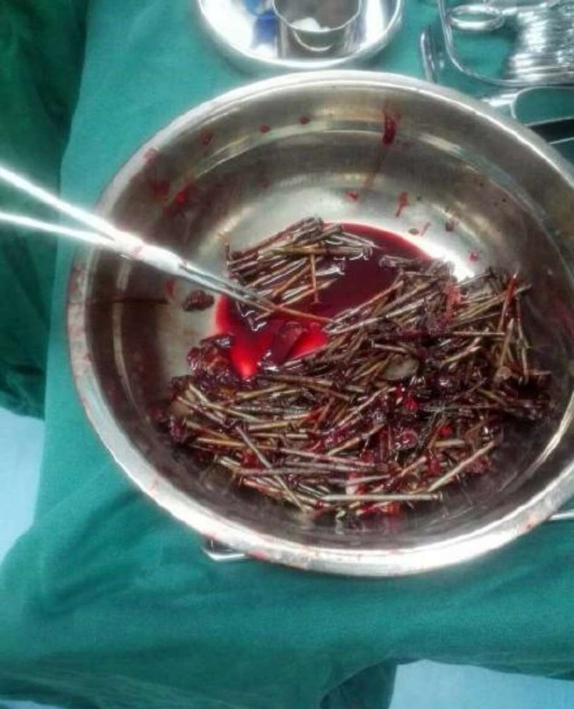 Foram retiradas cerca de 700 gramas do estômago do menino Foto: CEN / Reprodução