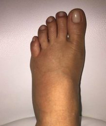 xuxa-posta-foto-do-pe-inchado