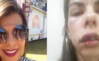 Jovem agredida pelo namorado publica fotos do rosto inchado em rede social