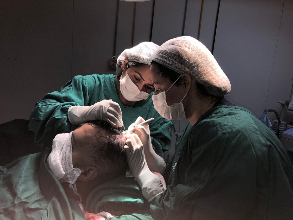 Transplante capilar ganha força em AL com sistema desenvolvido por Hospital Veredas