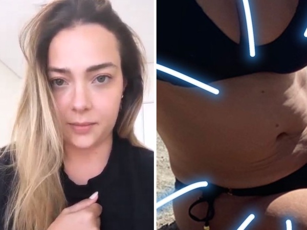 Carol Dantas explica procedimento estético na barriga: “Flacidez me incomoda”