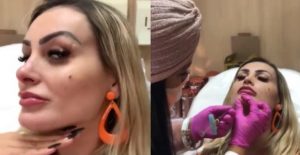 Andressa Urach faz preenchimento no queixo e nariz em clínica de biomédica alagoana
