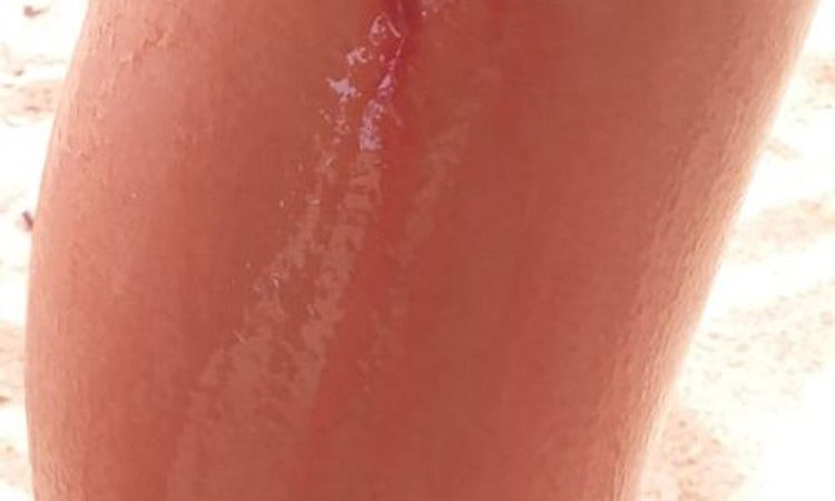 Banhistas ficam feridos após ataque de piranhas em Pão de Açúcar