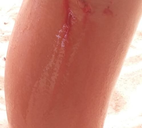 Adolescente fica ferido após ser atacado por piranhas em Pão de Açúcar