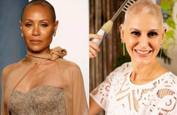 Esteticista fala da vida com alopécia, doença da mulher de Will Smith
