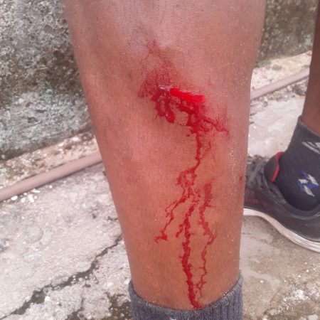 Gari se corta com pedaço de vidro durante coleta de lixo em Penedo