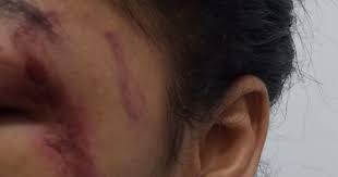 Violência Doméstica em Maceió: Mulher de 31 anos sofre agresões no rosto e tórax pelo companheiro