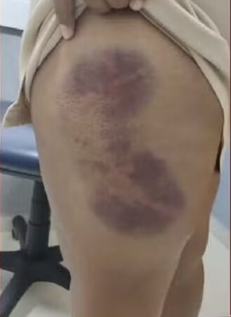 Homem tenta arrancar dedos dos pés da esposa com alicate e é preso em Novo Lino, AL