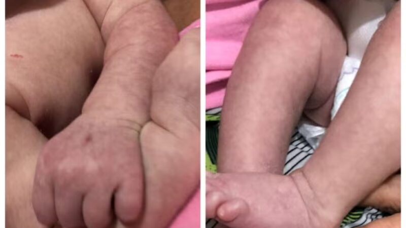 Bebê de 22 dias morre de dengue em Maceió; AL registra aumento de casos da doença