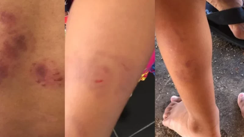 Professoras de escola que criança levou 19 mordidas são indiciadas por negligência