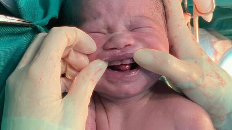 Bebê nasce com seis ‘dentes’ e surpreende equipe médica em MS