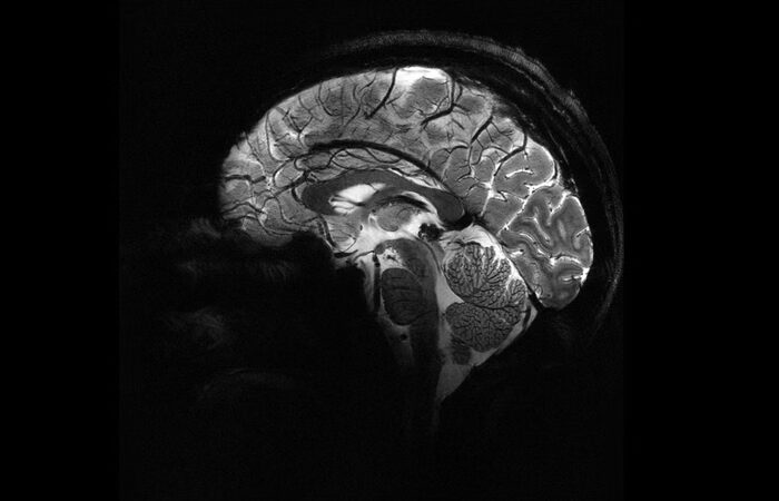 Estudo descobre como o sono higieniza o cérebro e afasta o Alzheimer