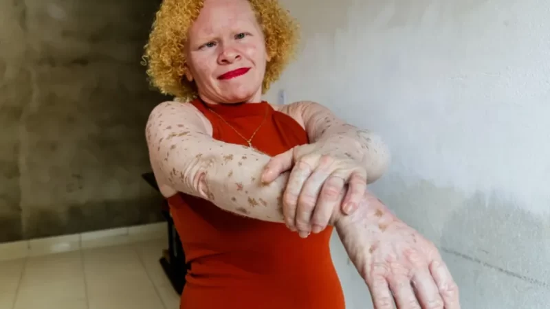 Alagoana transforma experiências em conhecimento para ajudar albinos