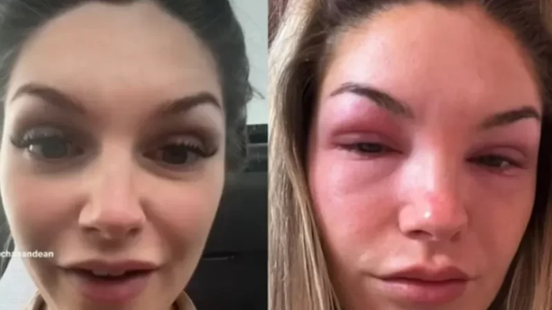 Mulher desenvolve alergia após colocar extensão de cílios postiços