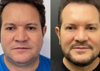 Ximbinha mostra antes e depois de procedimento estético