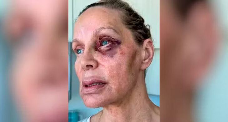 Ex de Nicolas Cage revela ferimentos causados por agressões sofridas pelo filho