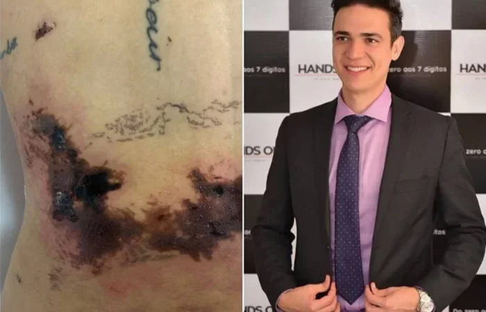 “Autoestima roubada”, diz empresária que teve necrose após lipo