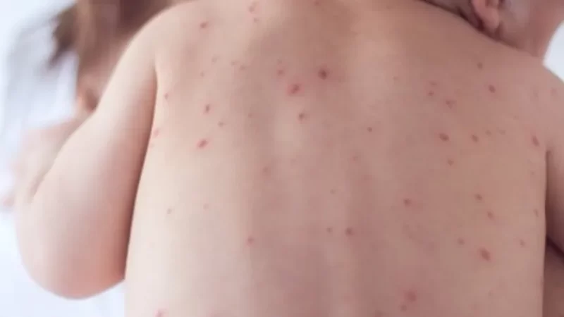 Menina de 5 anos é mais uma vítima de meningite em Alagoas