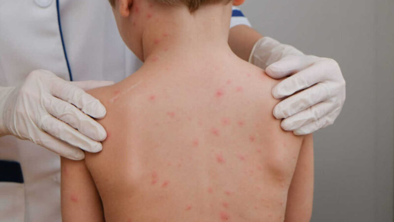 Meningite avança em Maceió: Ministério da saúde envia equipe para evitar epidemia