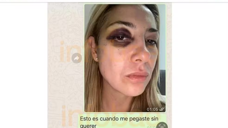 Ex-primeira-dama da Argentina mostra hematomas no olho e no braço após agressões de Alberto Fernández