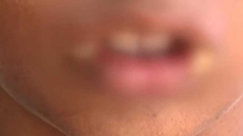 Avó e marido são presos suspeitos de queimar boca do neto com ovo quente