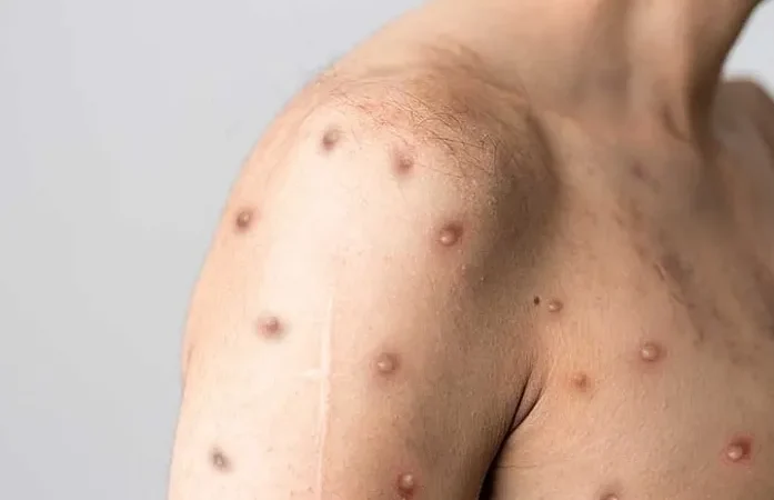 Mpox: infectologista explica transmissão, sintomas e prevenção da doença que também é considerada IST; Alagoas tem registro de 27 casos