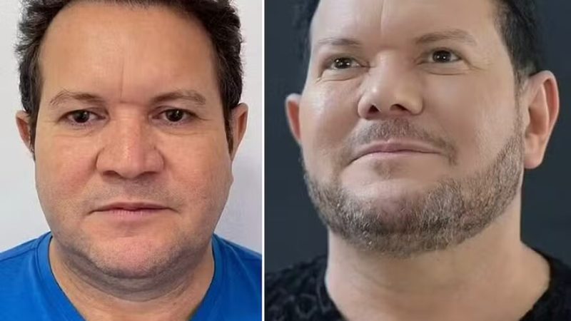 Ximbinha faz nova harmonização facial e exibe resultado; veja