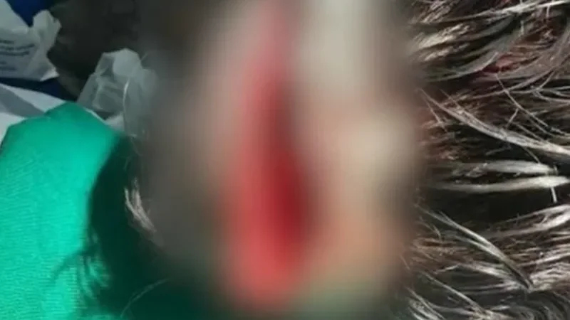 Aluno atingido na cabeça por janela no Cepa está acamado e sem andar