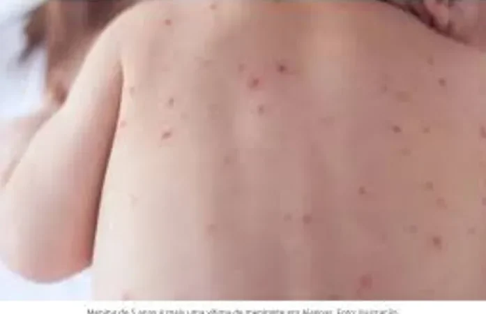 Alagoas registrou oito mortes por meningite e 21 casos confirmados da doença em 2024, diz Sesau