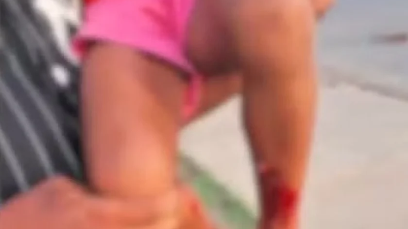 Menina é atacada por pitbull em condomínio de Maceió; tutor foi preso