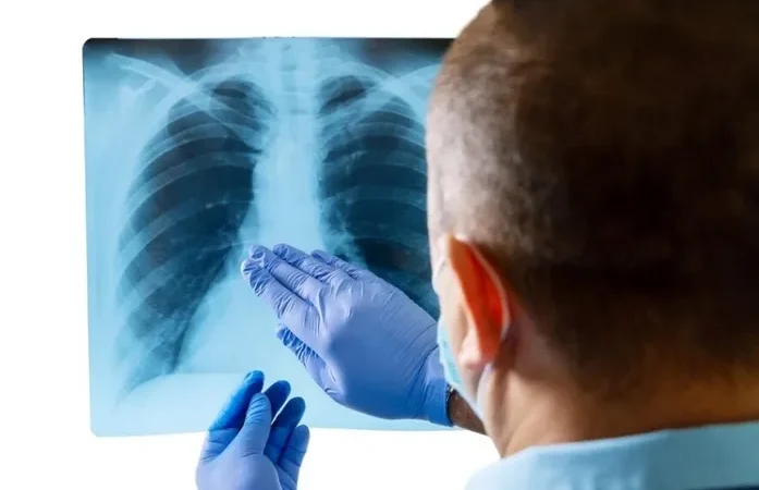 Unidades de Saúde realizam Dia D para identificar casos de tuberculose em Maceió