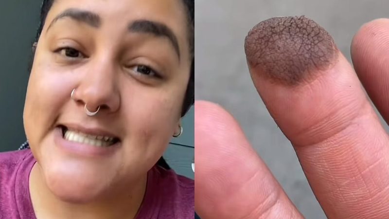 Mulher precisa depilar dedo após fazer enxerto com pele da virilha