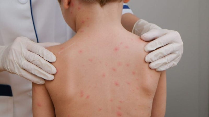 Alagoas aciona Ministério da Saúde diante de alta de casos de meningite