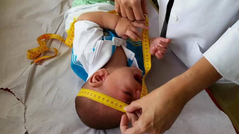 Justiça determina realização urgente de cirurgias em crianças com microcefalia em AL