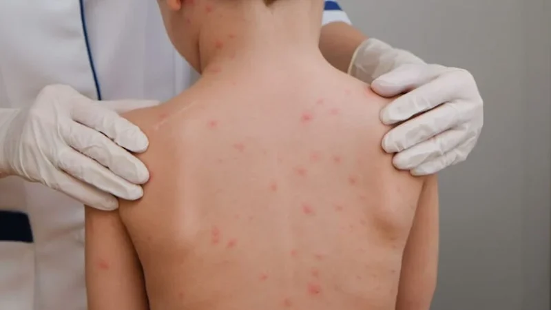 Caso suspeito de meningite no Farol é confirmado como viral, informa Secretaria de Saúde