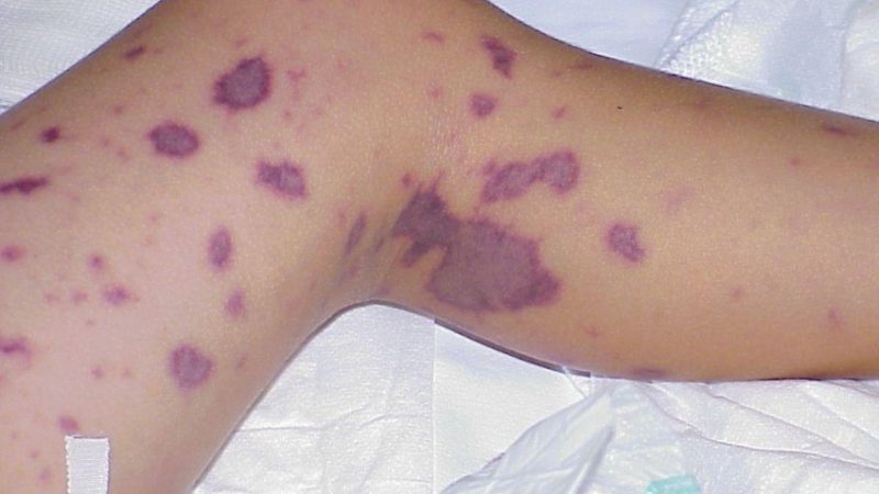 Bebê de 1 ano morre em Maceió após evolução rápida de meningite meningocócica tipo B