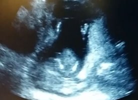 Ultrassom mostra feto batendo palmas enquanto mãe canta; assista