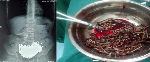 Médicos encontram 200 pregos em estômago de garoto na China