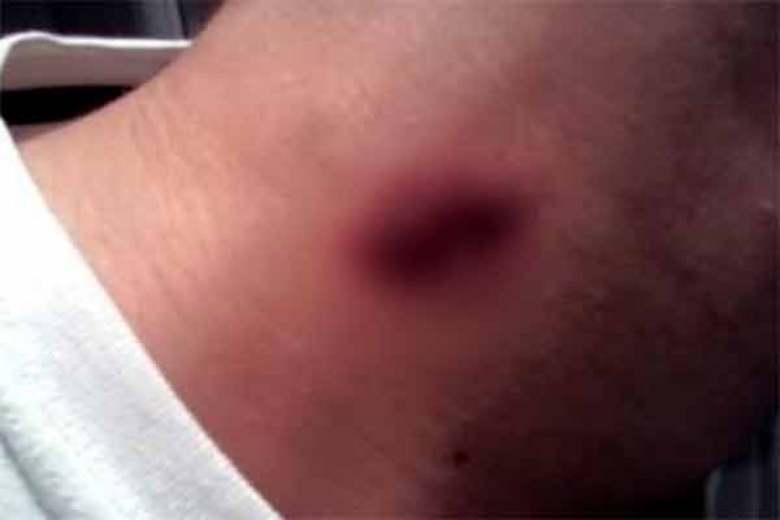 O “beijo” fatal: Jovem de 17 anos morre após levar chupão da namorada no pescoço