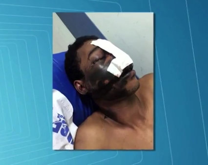 Homem sofre queimaduras no rosto após celular explodir em Atalaia