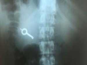 Preso engole chave durante rebelião e é internado para expelir