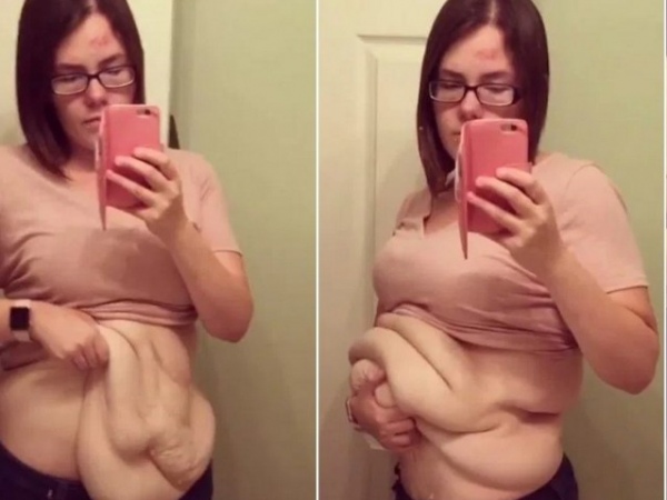Mulher que perdeu 63kg posta fotos de extrema flacidez