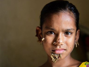 Menina é a primeira pessoa do sexo feminino com ‘doença do homem-árvore’