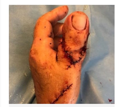 Homem tem dedo do pé implantado na mão