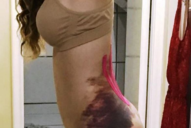 YouTuber tem infecção após implante de silicone no bumbum e mostra resultado na web