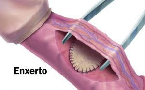 Doença que provoca deformação no pênis tem tratamento