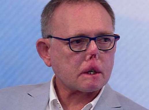 O homem que perdeu pernas, dedos e parte do rosto após arranhão e lambida de seu cão