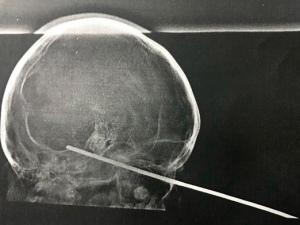 Menino de 8 anos tem espeto cravado no olho durante brincadeira com amigo na BA