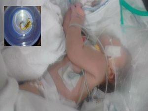 Bebê é picada cinco vezes por escorpião; animal foi encontrado no cordão umbilical