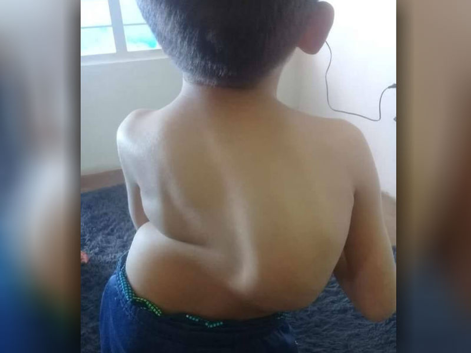 Garoto com escoliose avançada espera por cirurgia há mais de dois anos